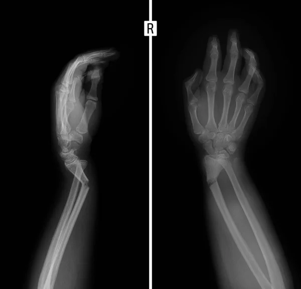 Рентген Зап Ясті Перелом Радіусу Грінстіка — стокове фото