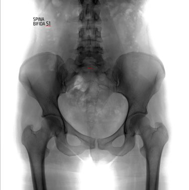 Lumbosakral omurga ve pelvis röntgeni. Spina bifida S1. Olumsuz. Marker.