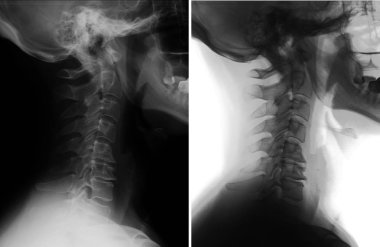 Servikal omurga röntgeni. Spondiloz, osteochondrosis. Servikal disfonksiyon. Negatif. 