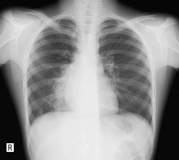 Röntgen Der Lungen Kind Mit Bronchopneumonie — Stockfoto