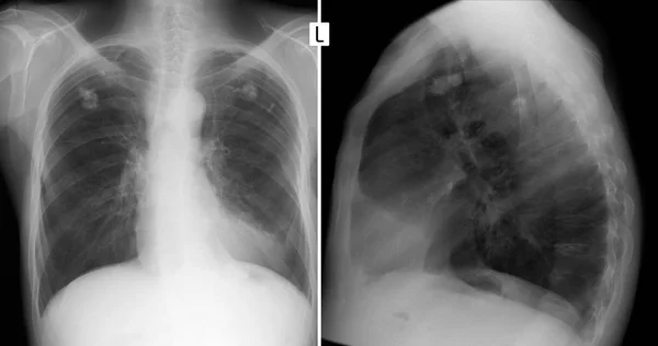 Rentgen Plic Změny Tuberkulóze Kalcifikace — Stock fotografie