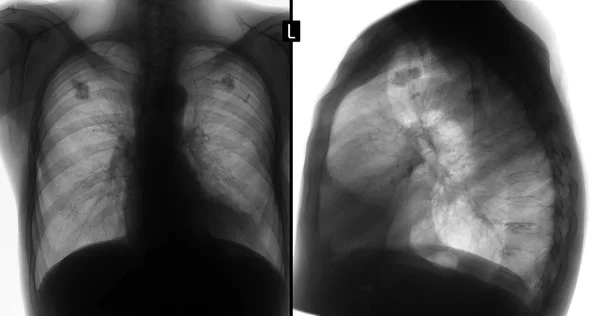 Röntgenfoto Van Longen Tuberculose Wijzigingen Kalkafzettingen Negatieve — Stockfoto