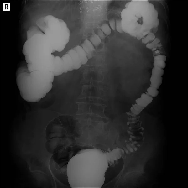 X-ray of the lower parts of the gastrointestinal tract (GI). Tight filling. Dolichocolon. Diverticulosis.