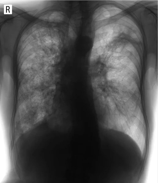 Raios Dos Pulmões Tuberculose Fibrocavernosa Negativo — Fotografia de Stock