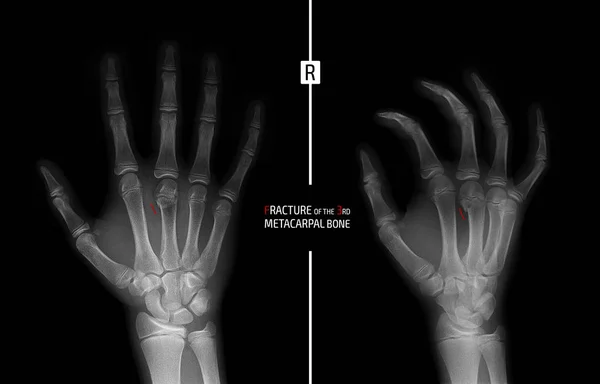 Radiographie Main Fracture Métacarpien Enfant Marqueur — Photo