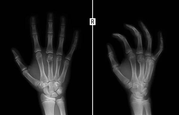 Röntgenfoto Van Hand Fractuur Van Middenhandsbeen Bone Het Kind — Stockfoto