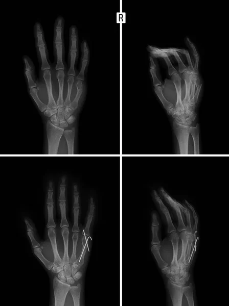 Işını 5Rd Metakarpal Kemik Kırığı Yeniden Konumlandırın Karşılaştırılan — Stok fotoğraf