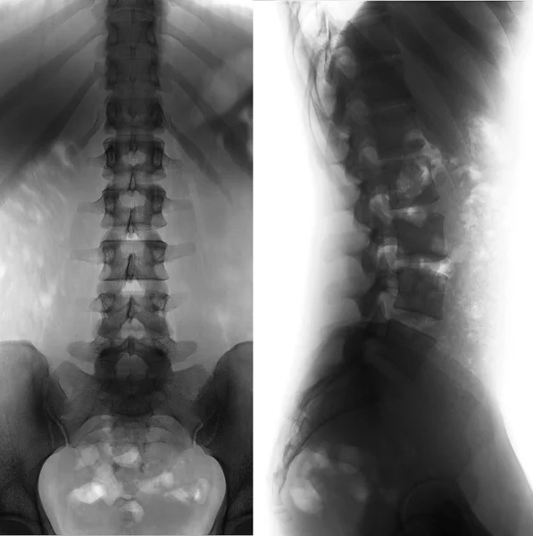 Radiografia Coluna Lombossacra Normal Negativo Perfeito — Fotografia de Stock