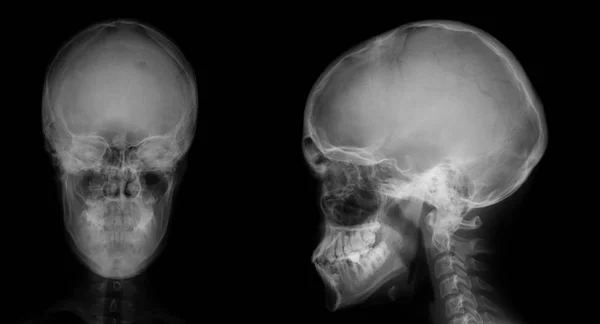 X-ray of the skull. Osteoid-osteoma of the frontal sinus.