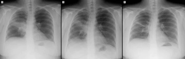 Röntgen Der Lungen Lungenentzündung Rechts — Stockfoto