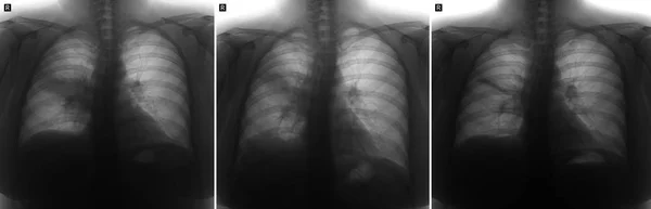 Röntgenfoto Van Longen Longontsteking Van Longen Terecht Negatieve — Stockfoto