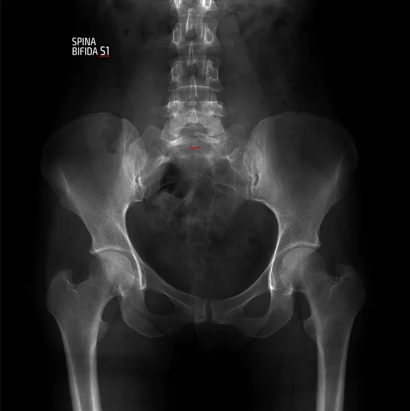 Radiografía Pelvis Columna Lumbosacra Espina Bífida Marcador —  Fotos de Stock