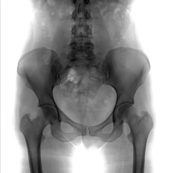 Radiografía Pelvis Columna Lumbosacra Espina Bífida Negativo —  Fotos de Stock