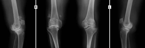 Térdízületek Röntgenje Arthrosis Deformálódása Stock Kép