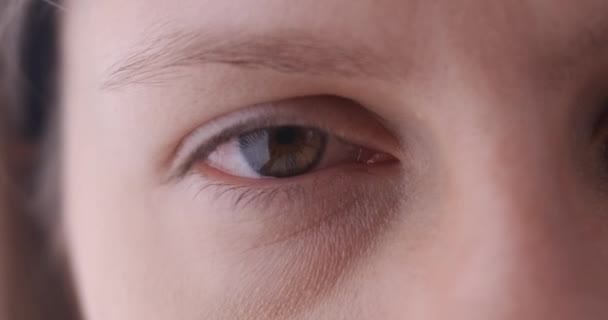 Nahaufnahme eines kranken Auges einer Frau, die mit einer Art Allergen infiziert war. Augapfel mit roter Vene, die juckt. — Stockvideo