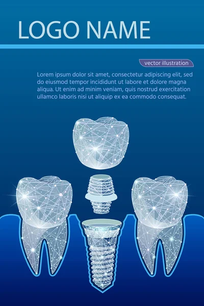 Sağlıklı dişler ve diş implantı. Diş Hekimliği. İnsan dişleri implantasyonu. Vektör çizim