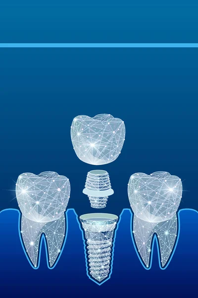 Healthy teeth and dental implant. Dentistry. Implantation of human teeth. Polygonal wireframe from dots and lines, abstract design. Digital graphics  illustration. For Poster, Cover, Label, Sticker, Business Card