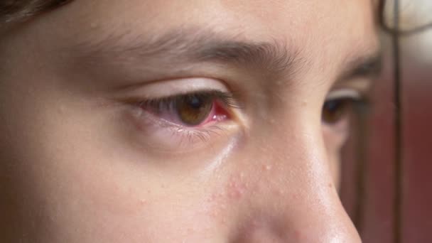 4K Primer plano. La niña muestra los ojos con conjuntivitis. El viral en el ojo . — Vídeo de stock