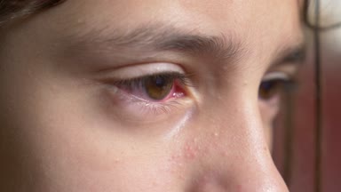 4k yakın çekim. Küçük kız konjonktivit gözlerle gösterir. Viral gözde.