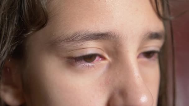 4K Primer plano. La niña muestra los ojos con conjuntivitis. El viral en el ojo . — Vídeos de Stock