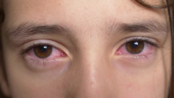 Εσωτερικη 4k. Μικρό κορίτσι δείχνει τα μάτια με επιπεφυκίτιδα. Η ιογενής στο μάτι. — Αρχείο Βίντεο