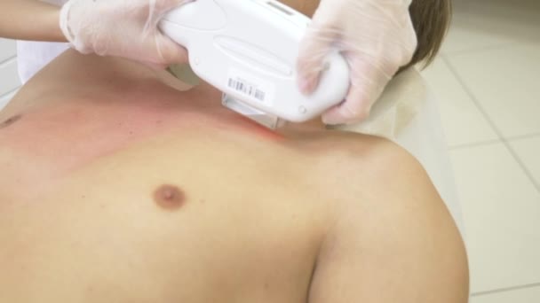 Manliga laser hårborttagning. en läkare i vita handskar avlägsnar hår från buken och brösten för en man. 4k, närbild. Slow motion — Stockvideo
