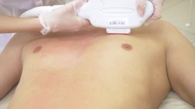 Erkek lazer epilasyon. Beyaz eldiven bir doktor karın ve göğüsler bir adamın saç kaldırır. 4k, yakın çekim. Ağır çekim.