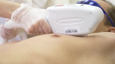Erkek lazer epilasyon. Beyaz eldiven bir doktor karın ve göğüsler bir adamın saç kaldırır. 4k, yakın çekim. Ağır çekim