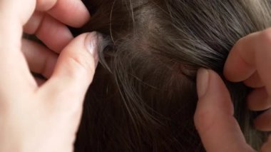 Yakın çekim. 4k, ağır çekim. Eller, üzerinde kahverengi saçlı kafa bitleri bulmak. pediculosis tedavisinde.