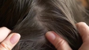 Yakın çekim. 4k, ağır çekim. Eller, üzerinde kahverengi saçlı kafa bitleri bulmak. pediculosis tedavisinde.