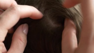 Yakın çekim. 4k, ağır çekim. Eller, üzerinde kahverengi saçlı kafa bitleri bulmak. pediculosis tedavisinde.