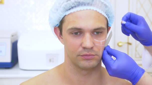 Mani del dottore Il cosmetologo fa segni sulla faccia dell'uomo con una matita. contorno faccia plastica. 4k. Rallentatore — Video Stock
