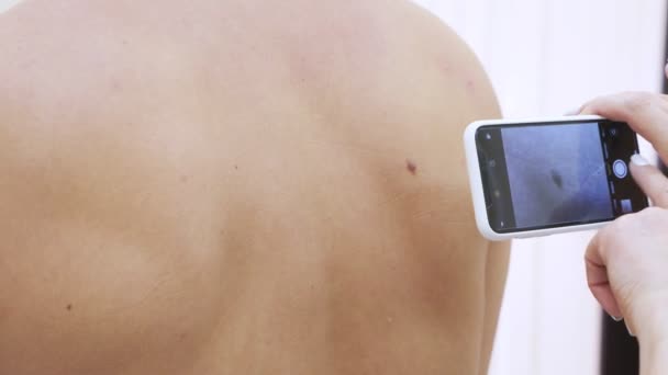 Läkaren dermatovenerologist gör ett foto av ett födelsemärke på en mans tillbaka på telefonen, innan förfarandet av laser borttagning av ett födelsemärke. 4k, närbild. slowmotion — Stockvideo