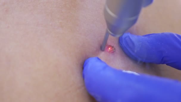 The doctor dermatovenereologist burns a birthmark on the back of a man with a laser beam. 4k, close-up. Slow motion — Stock Video