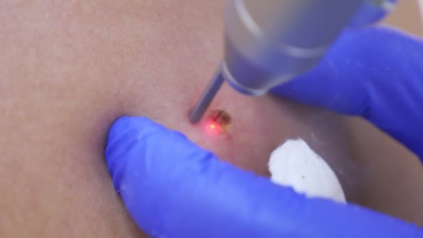Врач дерматовенеролог сжигает родимое пятно на спине человека лазерным лучом. 4К, крупный план. Медленное движение — стоковое видео