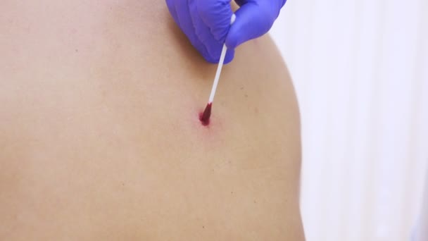 皮肤科医师 用防腐剂从一个人的背部抹去的痣上的疤痕 慢动作 激光去除胎记的程序 — 图库视频影像