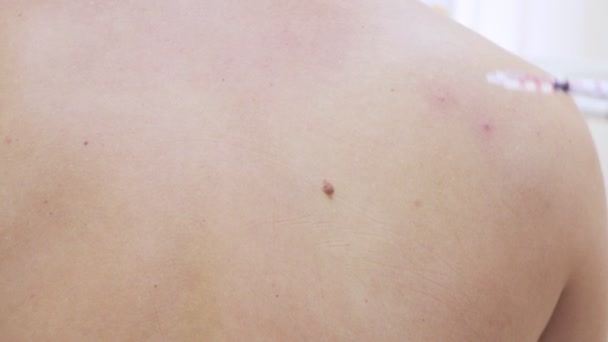 Lekarz dermatovenereologist sprawia, że po wstrzyknięciu znieczulenia w Kret z tyłu mężczyzna, przed zabiegiem laserowego usuwania Mole. 4k, szczegół. zwolnionym tempie — Wideo stockowe