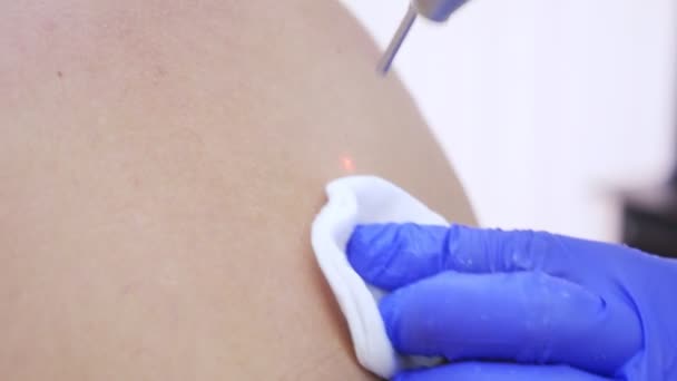 Den läkare dermatovenereologist bränner ett födelsemärke på baksidan av en man med en laserstråle. 4k, närbild. Slow motion — Stockvideo