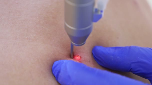 O médico dermatovenereologista queima uma marca de nascença na parte de trás de um homem com um feixe de laser. 4K, close-up. Movimento lento — Vídeo de Stock