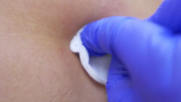 Un dermatologue, un médecin, frotte une cicatrice d'une taupe juste retirée du dos d'une personne avec un antiseptique. 4k, gros plan. Au ralenti. procédure d'enlèvement laser d'une tache de naissance — Video