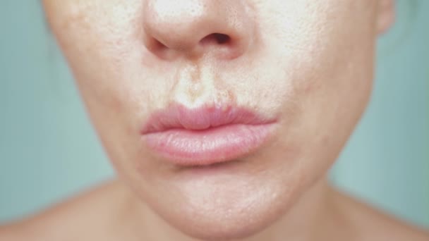 Herpes en los labios femeninos. 4k, primer plano, fondo azul, desenfoque, cámara lenta — Vídeos de Stock