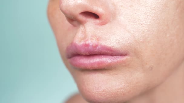 Herpes en los labios femeninos. 4k, primer plano, fondo azul, desenfoque, cámara lenta — Vídeos de Stock