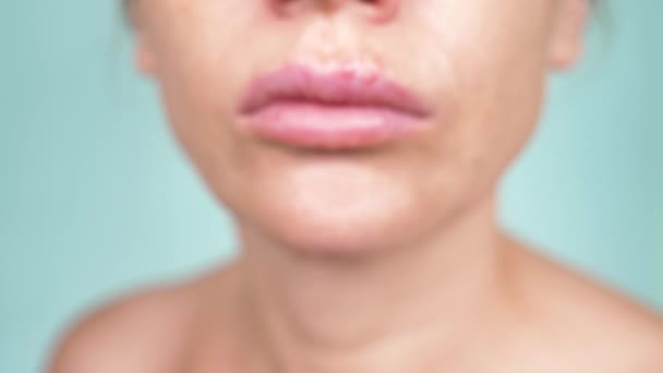 Герпес на женских губах. 4k, крупный план, синий фон, размытие, замедленная съемка — стоковое видео