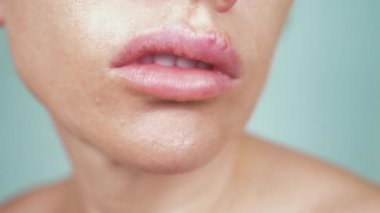 kadın dudaklarında uçuk. 4k, yakın çekim, mavi arka plan, bulanıklık, ağır çekim