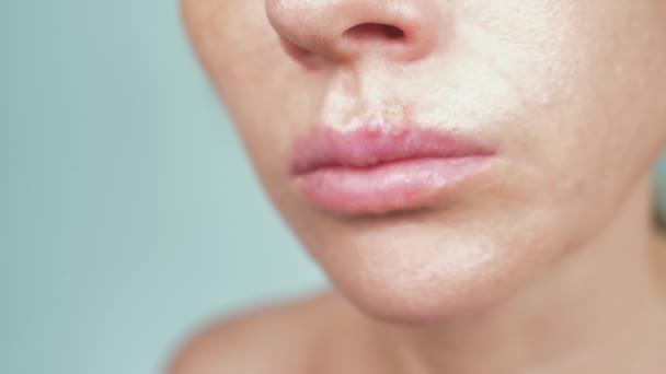 Herpes auf den weiblichen Lippen. 4k, Nahaufnahme, blauer Hintergrund, Unschärfe, Zeitlupe — Stockvideo