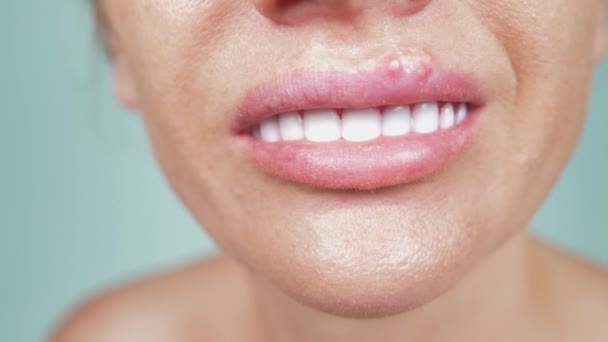 Herpes Auf Den Weiblichen Lippen Nahaufnahme Blauer Hintergrund Unschärfe Zeitlupe — Stockvideo