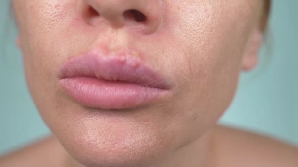 Herpes en los labios femeninos. 4k, primer plano, fondo azul, desenfoque, cámara lenta — Vídeos de Stock