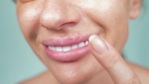 Herpes sulle labbra femminili. 4k, primo piano, sfondo blu, sfocatura, rallentatore — Video Stock