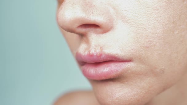 Herpes sulle labbra femminili. 4k, primo piano, sfondo blu, sfocatura, rallentatore — Video Stock