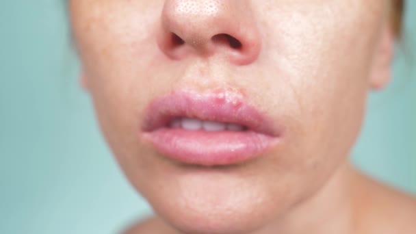 Herpes en los labios femeninos. 4k, primer plano, fondo azul, desenfoque, cámara lenta — Vídeos de Stock